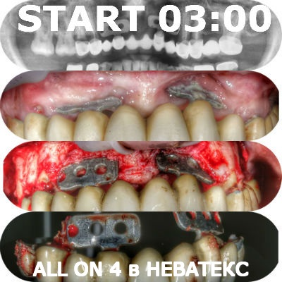 фото этапов операции all on 4 на верхней челюсти фото этапов операции all on 4